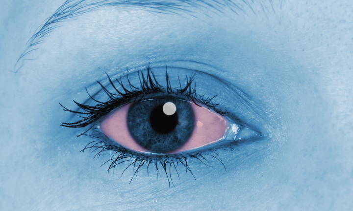10 Most Common Causes Of Red Eye