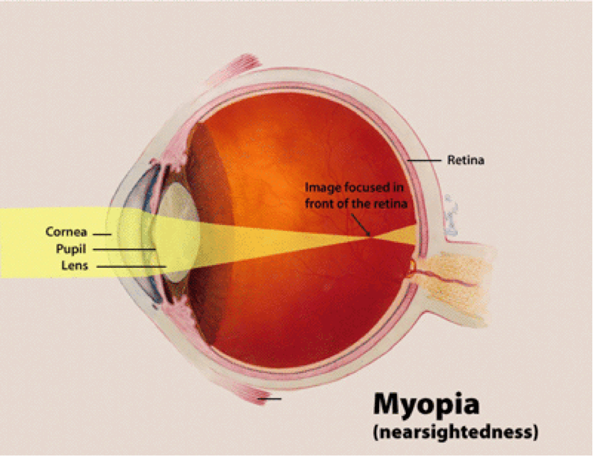 Are you near-sighted or far-sighted?