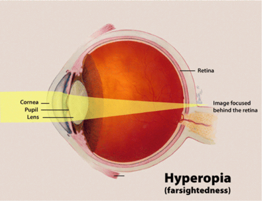 What is Nearsightedness and Farsightedness?